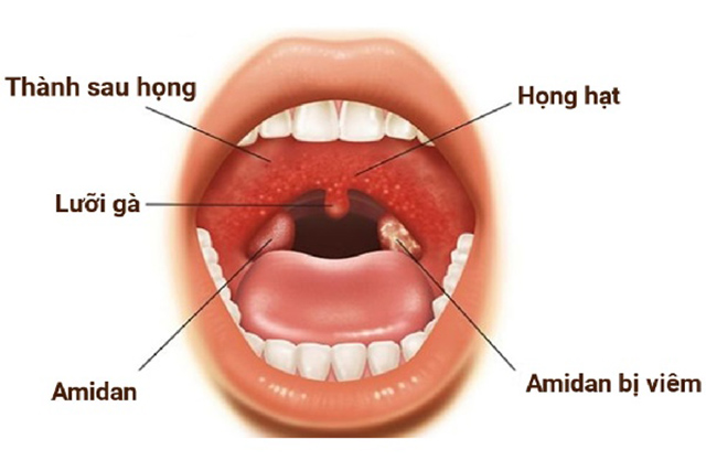 Nguyên nhân của bệnh viêm họng hạt