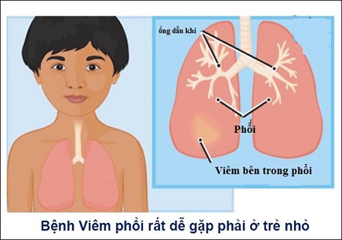 Viêm phổi là gì?