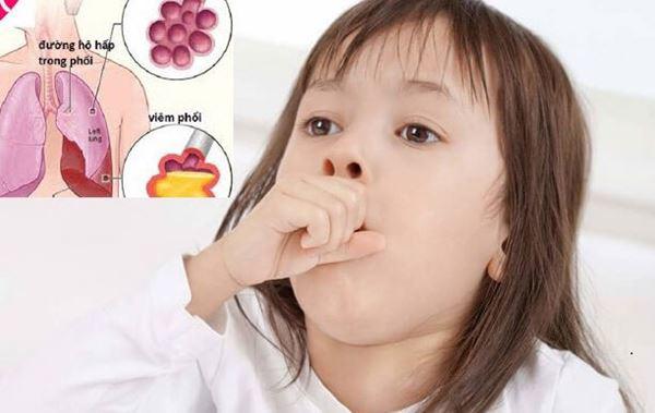 Hai loại viêm phổi ở trẻ em