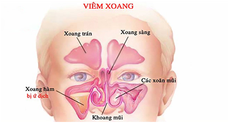 nguyên nhần gây viêm mũi xoang